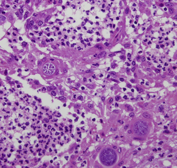 What is the likely pathogen found in the spherical cysts in this cytology?