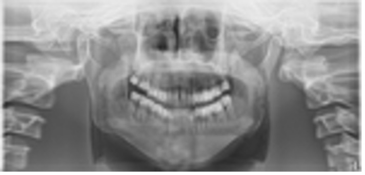 <p>The smile line is exaggerated, the mandibular incisors appear blurry and elongated, and the condyles are cut off</p>