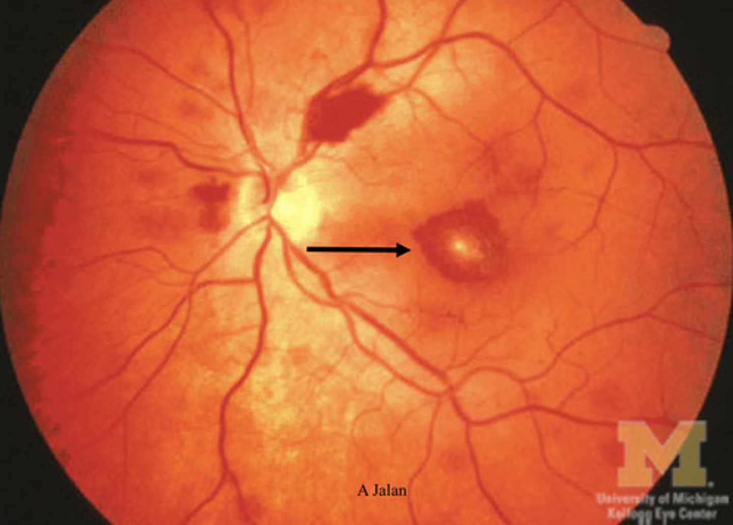 <p>- retinal hemorrhage -&gt; leaky RBCs produced</p><p>- cotton wool spots -&gt; portions that die off due to no vascularization</p><p>- vessel tortuosity -&gt; squiggly vessels</p><p>- conjunctival pallor -&gt; white under eyes</p>