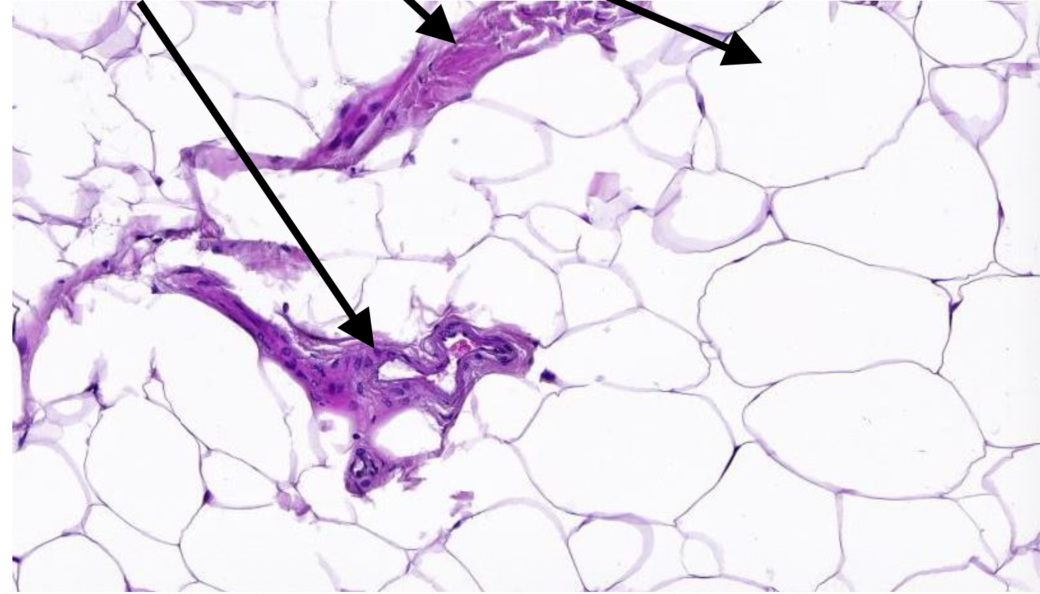 <p>pathologische kenmerken lipoom</p>
