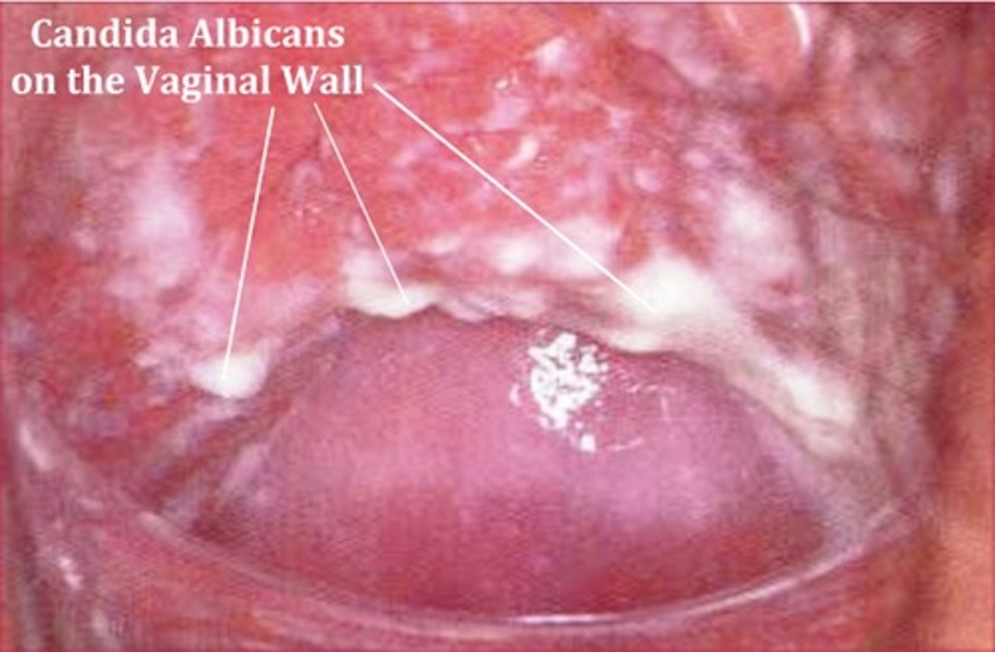 <p>causes thrush, vaginitis</p>