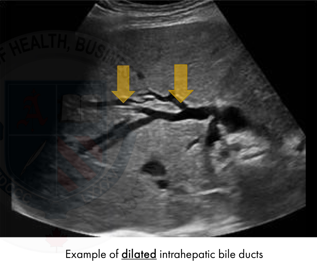 <p>NOT seen in normal patients </p><p>Small ducts that join together into larger ducts, ending in the left and right hepatic ducts </p>