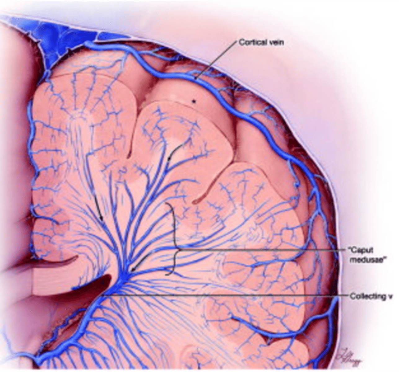 <p>most common</p><p>primitive embryologic veins in a radial pattern feeding a central vein</p>