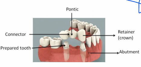 <ul><li><p>Retainer - part that seats on the abutment tooth </p></li><li><p>Pontic - suspended member of FPD that replaces the missing tooth </p></li><li><p>Connector - provide connection between the retainer and pontic </p></li><li><p>Abutment tooth - the tooth that provides support for the retainer </p></li></ul><p></p>