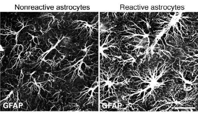 <ul><li><p>modifcation fontionnelle → augmentation de l expression de plusieurs genes (GFAP, cytokines pro-inflammatoires, facteurs de croissances neuronales)</p></li><li><p>production des molecules inflammatoires</p></li><li><p>synthese et secretion des facteurs trophiques qui stimulent la croissance des neurones</p></li><li><p>participation a l elimination des debris cellulaires et en particulier des terminaisons synaptiques (Avec la microglie) grace a la phagocytose</p></li><li><p>formation de la cicatrice gliale (processus se chevauchent) qui limite l extension des dommages</p></li><li><p>soma grandit</p></li><li><p>processus plus epais et plus nombreux</p></li><li><p>modifications de la quantite de canaux et de transporteurs, car le controle de la barriere hematoencephalique baisse</p></li></ul><p></p>