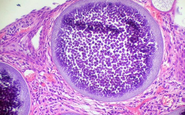<p>Cause; histo description; most common location? </p>