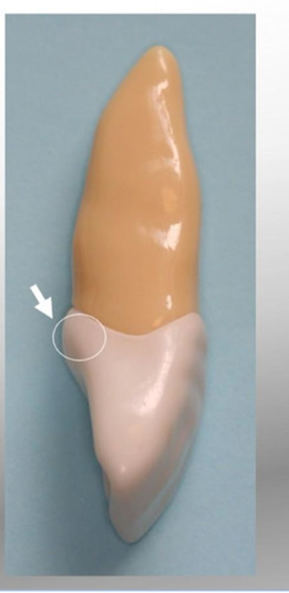 <p>Enlargement or bulge on lingual of all anterior teeth</p>