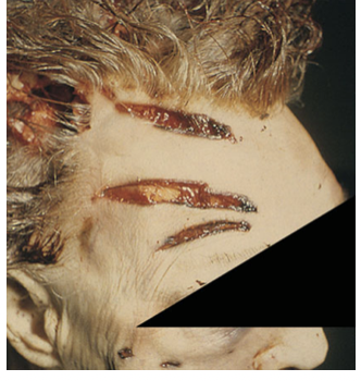 <p><span>occurs by crushing of the skin between two hard objects</span></p>