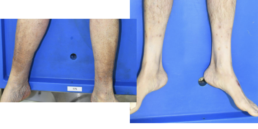 <p>brown-tan hyperpigmented change of lower extremities, often bilateral; circumferential or patchy hair loss</p>