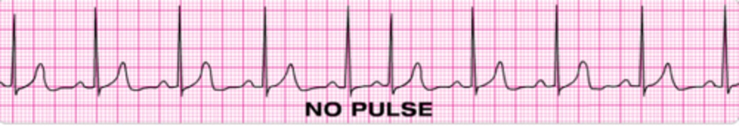 <p>Identify the rhythm.</p>