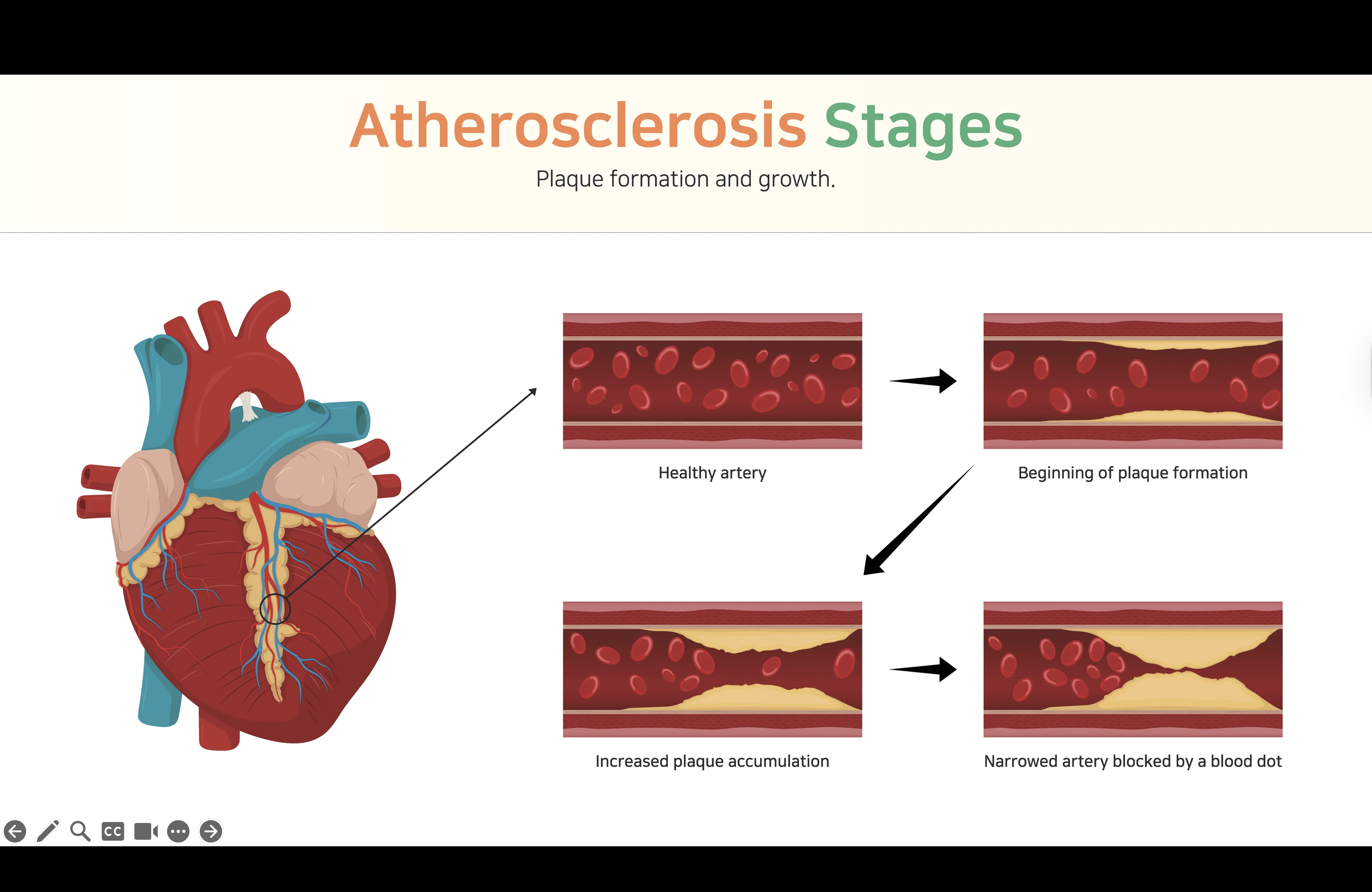 <ul><li><p>Arteriosclerosis is a thickening, or hardening, of the arterial wall that is often associated with aging → Atherosclerosis, a type of arteriosclerosis</p></li><li><p>Atherosclerosis involves the formation of plaque within the arterial wall and is the leading risk factor for CVD. </p></li><li><p>Usually affects the larger arteries, such as coronary artery beds; aorta; carotid and vertebral arteries; renal, iliac, and femoral arteries</p><p></p><p></p><p></p></li></ul><p></p>