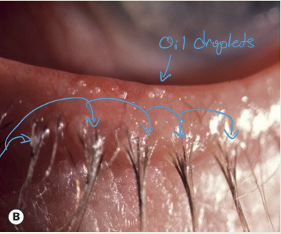 <p>Lid hygiene</p>