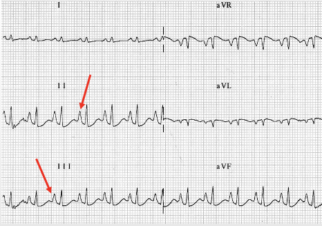 <p>Leads I, II, III: upright P taller than 2.5 mm</p><p>Lead V1: biphasic P w/ bigger + initial deflection &amp; smaller - terminal deflection</p>