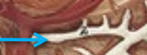 <p>A smaller pancreatic duct that branches off the main pancreatic duct and may also empty into the duodenum, usually superior to the major duodenal papilla.</p>