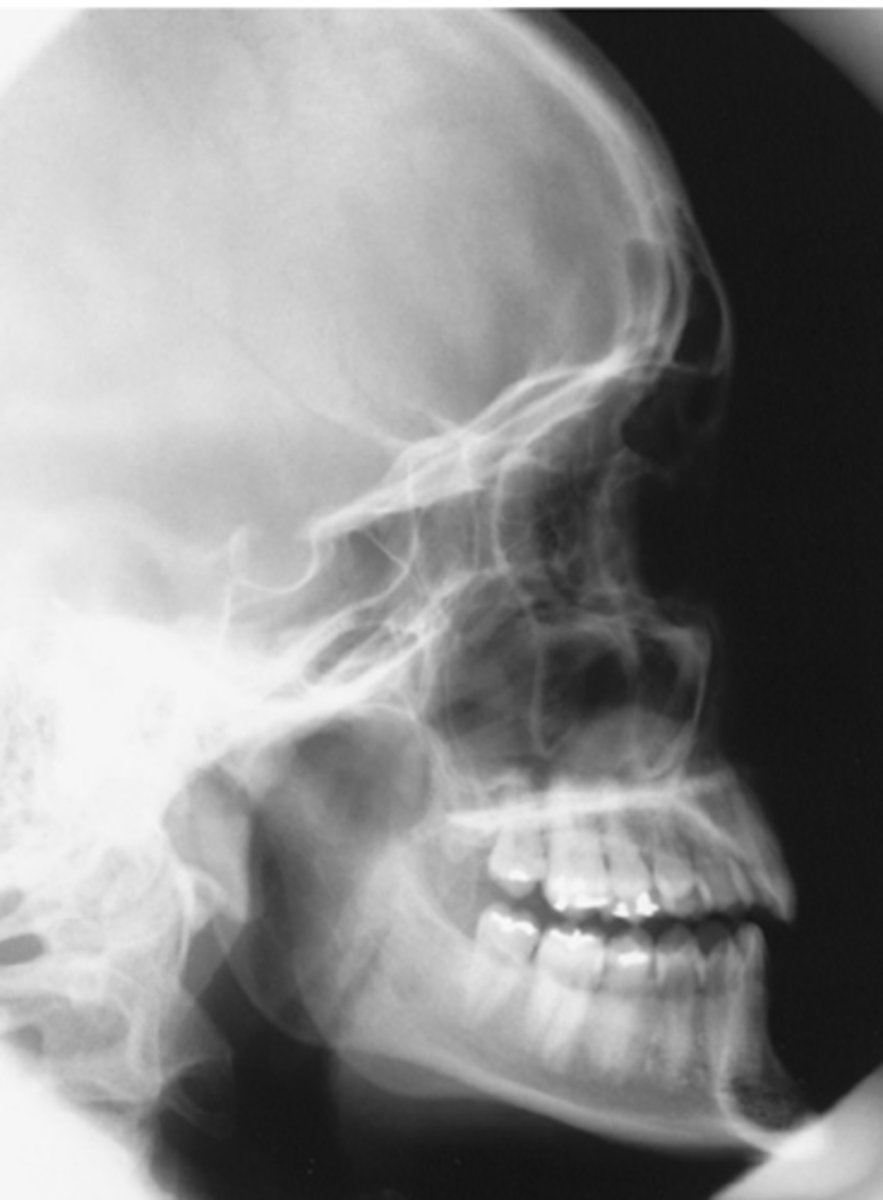 <p>Repeatable errors (two)—</p><p>Criterion 2: Positioning: Skull is rotated. (Note the separation of rami of mandible, greater wings of sphenoid, and orbits.) </p><p>Criterion 5: Anatomic side markers: No anatomic side marker is visible</p>