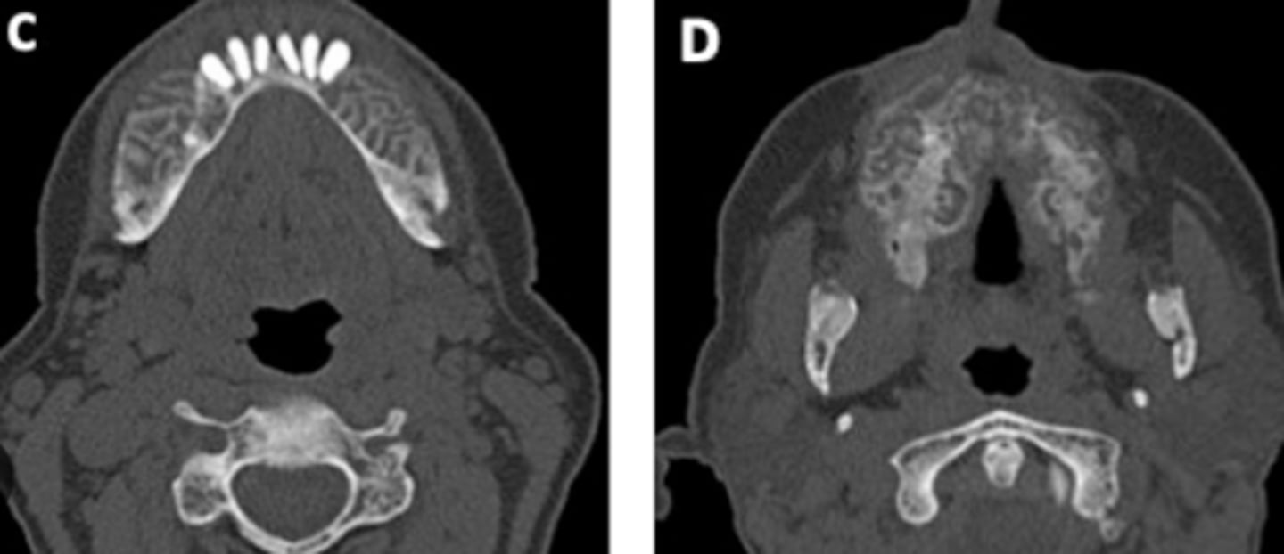 <p>renal osteodystrophy</p>