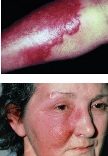 <p>§ Malaise, fever, chills 48 hours before onset of rash</p><p>§ Infection of superficial dermis</p><ul><li><p>Can extend to superficial cutaneous lymphatics</p></li><li><p>Peau d’orange (orange peel skin)</p></li></ul><p>§ Area of erythema is well demarcated, raised</p><p>§ Fast development</p><p>§ Often affects the lower extremities</p><ul><li><p>Face second most common</p></li></ul><p>§ Burning, pain, itchy</p><p>§ Group A Strep</p><p>§ Outpatient: Penicillin or amoxicillin</p>