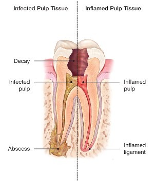 <p>dental procedure to save tooth with infected or inflamed pulp</p>