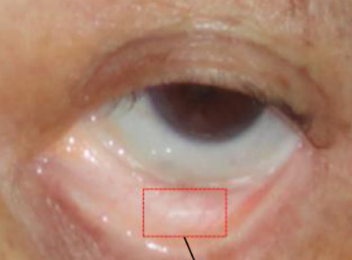 <p>Which conjunctiva is this?</p>