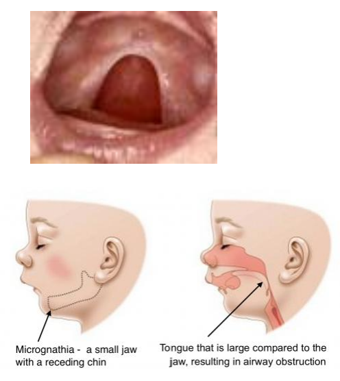 <p>CP oten seen in Pierre Robin malformation sequence </p>