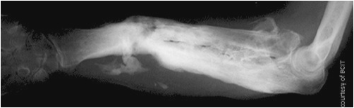 <p>Osteomyelitis</p>