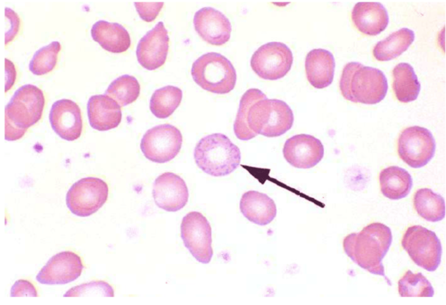 <p>-Basophilic Stippling</p><p>-hct and hb moderately low</p><p>-normochromic and normocytic or hypochromic and microcytic</p><p>-Eosinophilia</p>