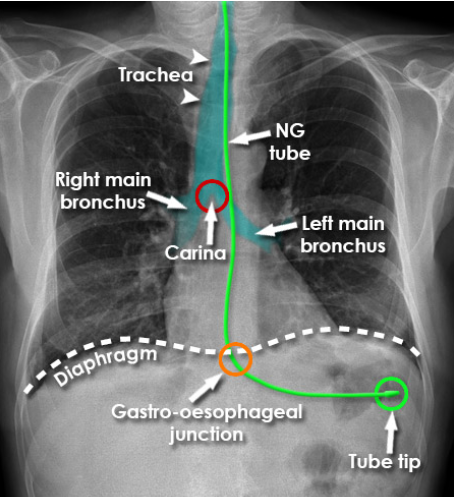 <p>At least 10 cm below the diaphragm, within the stomach, over the gastric bubble.</p>