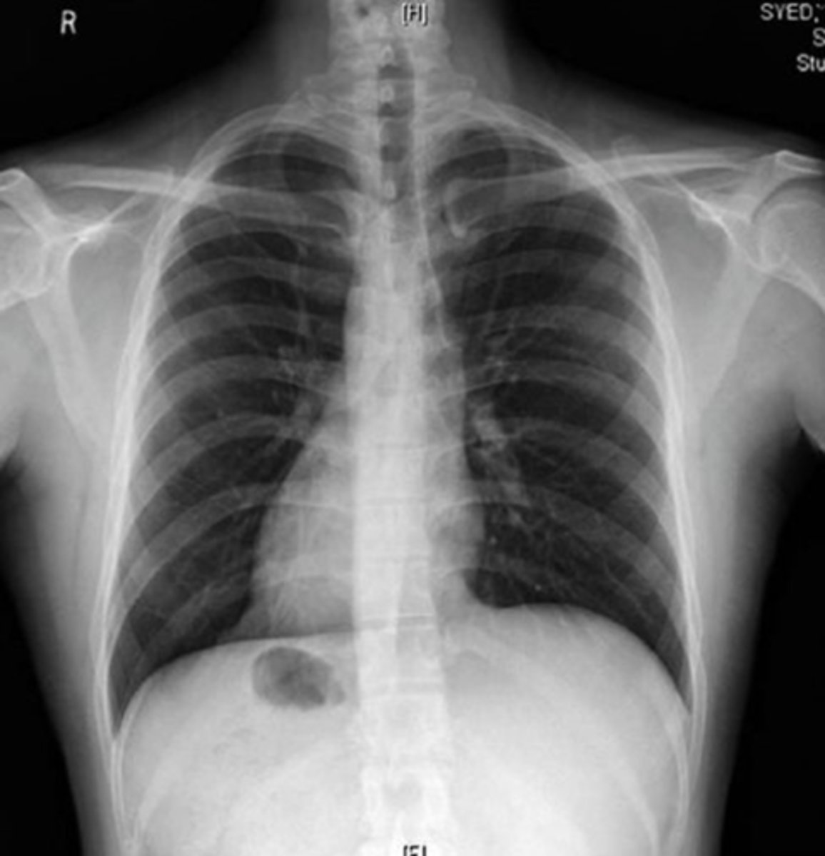 <p>heart displaced to the right caused by defect in body axis development</p>
