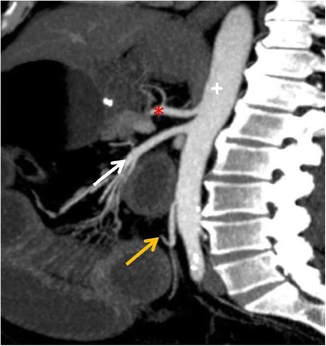 <p>What is the white arrow artery</p>