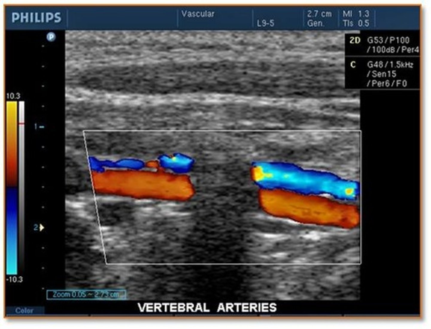 <p>normal shadowing from the spinal processes</p>