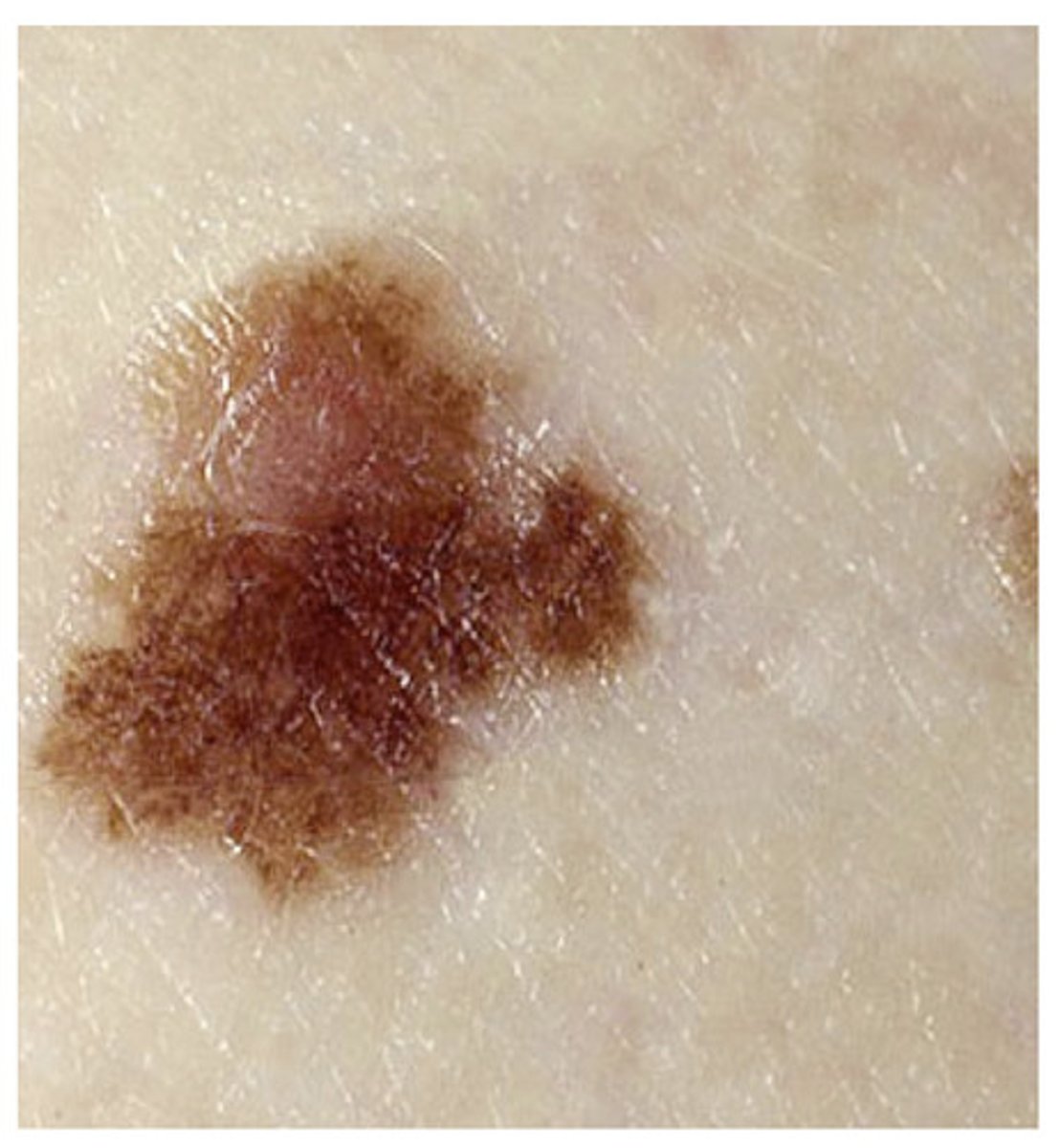 <p>-a melanocytic proliferation showing atypia and sharing some features of melanoma</p><p><strong>-controversial d/t lack of consensus on how it is defined and what it represents biologically: graded mild, mod, or severe</strong></p><p>-believed to correlate with the overall number of melanocytic lesions in an individual</p><p>-4-15 fold increased risk of melanoma</p>