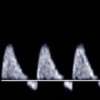 <p>This is a doppler at the umbilical artery.</p><ol><li><p>What waveform is seen here?</p></li><li><p>Is it normal or abnormal?</p></li></ol><p></p>