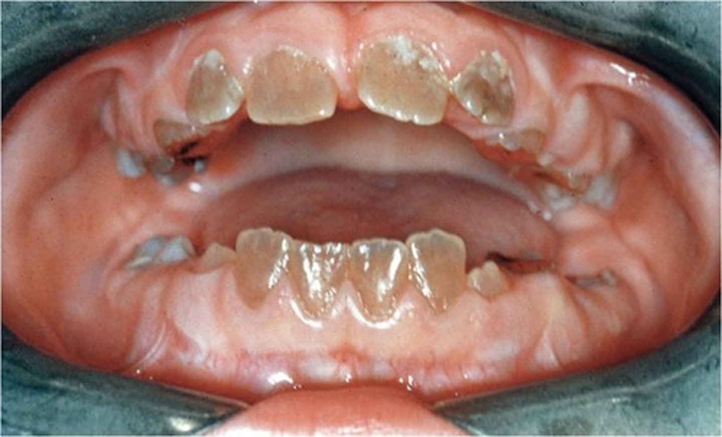 <p>-Inherited dentin disorder</p><p>-Teeth are discolored-opalescent dentin</p><p>-Poor dentin formation compromised normal enamel</p><p>-Radiographically-abnormal pulp and crown</p>