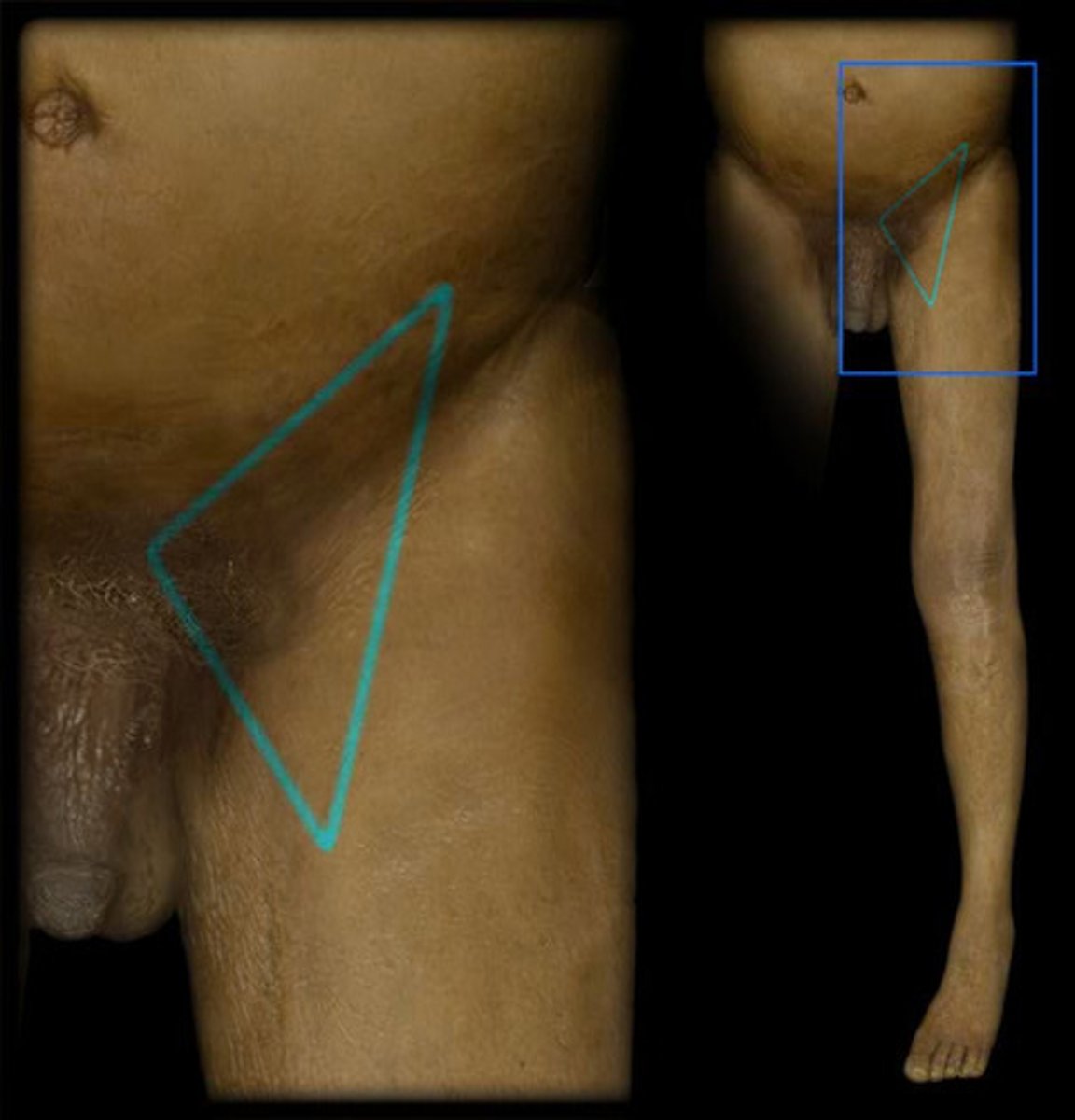 <p>3 borders of the femoral triangle (superior, lateral, medial)</p>