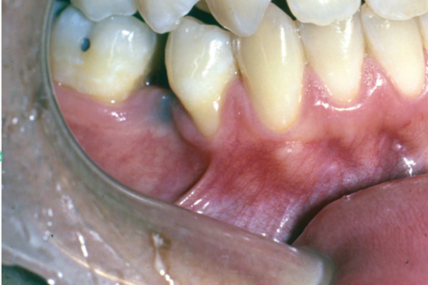 <p>What is this recession caused by?</p><p>• hint: look at neighboring teeth for recession</p>