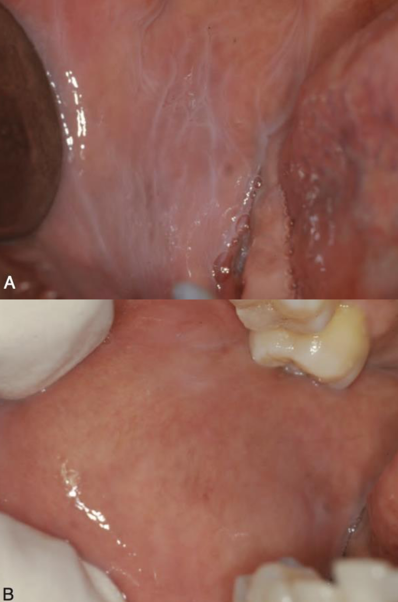 <p>which environmental/reactive lesion:</p><ul><li><p>Delicate lacy, gray-white lines on the buccal mucosa or ventral tongue</p></li><li><p>Disappears on stretching the mucosa</p></li><li><p>Very common</p></li><li><p>Mildly irritating substances</p><ul><li><p>Smoke from tobacco products or marijuana</p></li><li><p>caustic oral rinses, or toothpaste</p></li></ul></li><li><p>Traumatic, parafunctional habit such as mucosal sucking</p></li><li><p>No treatment required</p></li></ul><p></p>