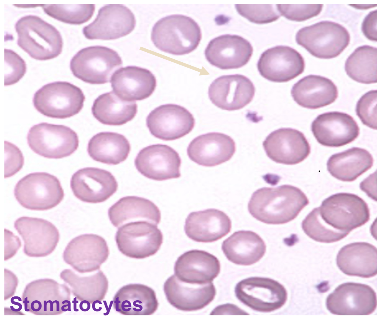 <p>spherocytes (appear microcytic and hyper chromic due to loss of central pale area)<img src="https://knowt-user-attachments.s3.amazonaws.com/35b53446-4d10-4fbe-94c7-7d5b74c8ea12.png" alt="knowt flashcard image" width="150" height="150"></p><p>stomatocytes (rectangular or slit-like central pale area)</p>