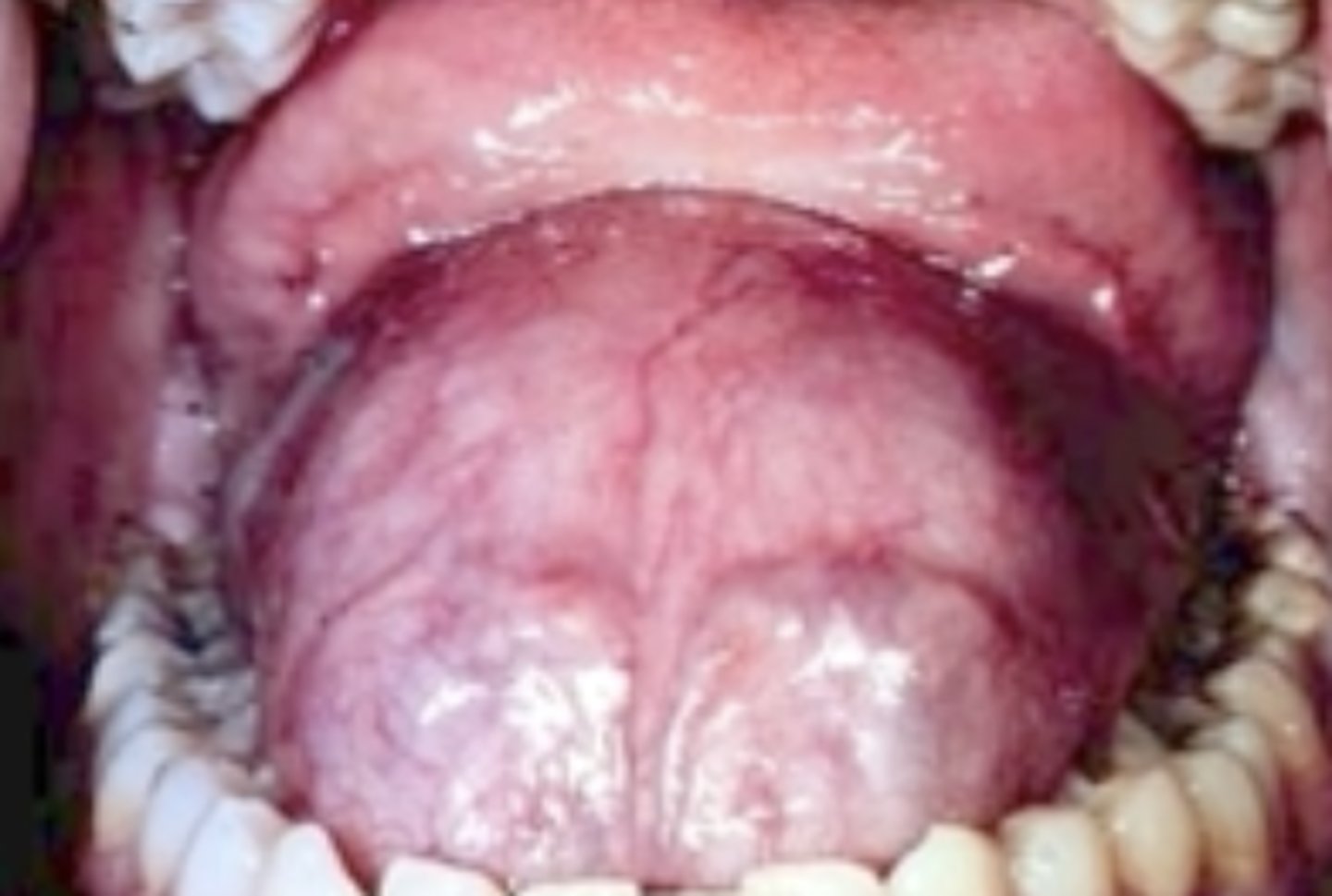 <p>dough-like swelling at midline </p><p>• keratin filled</p><p>• cyst wall: hair follicles, sebaceous/sweat glands</p><p>• common location: anterior floor of mouth</p><p>• population: children</p>