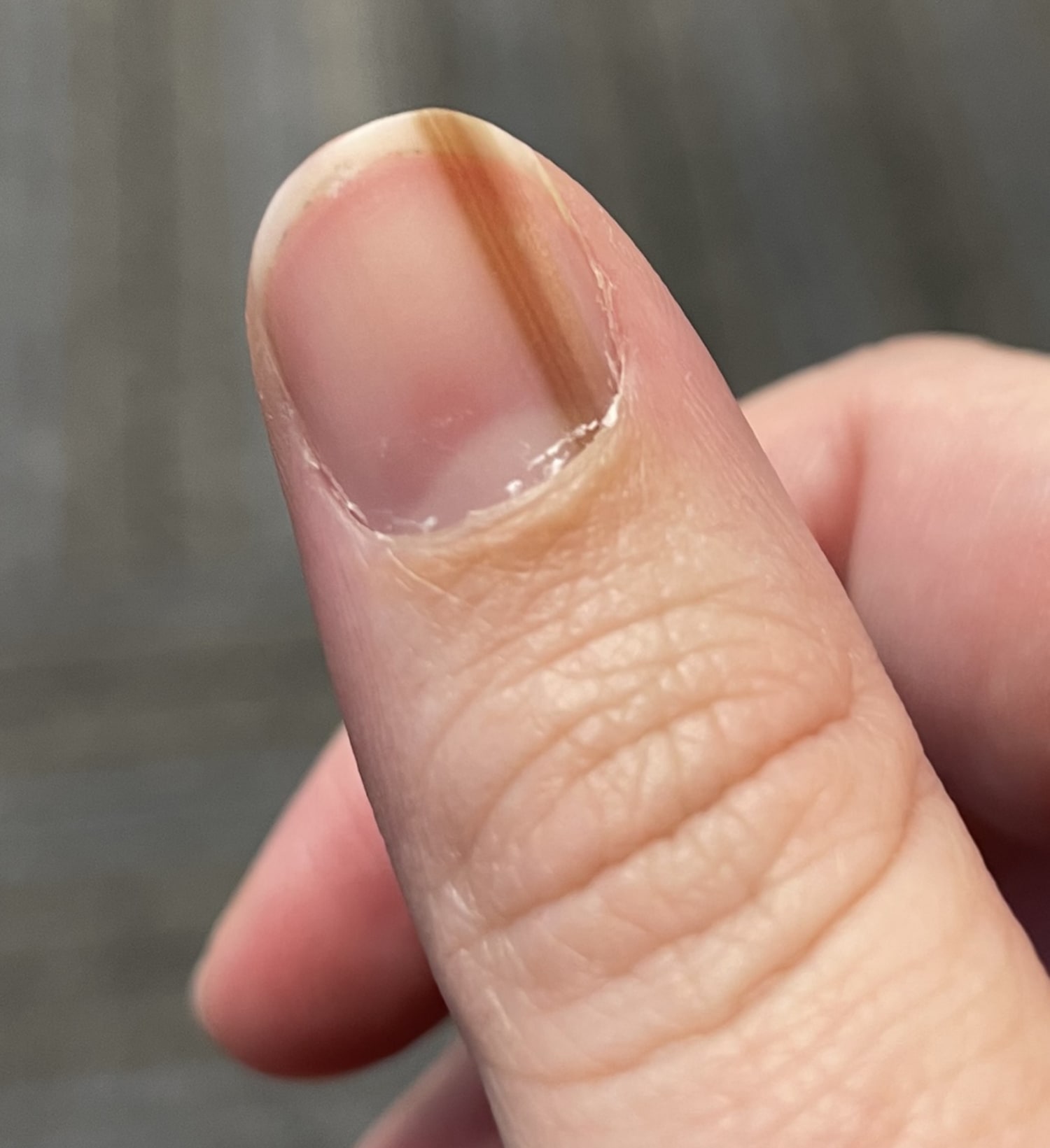 <p>brown linear streaks on fingernails</p>