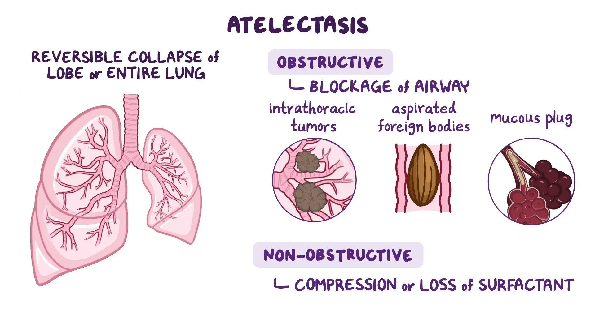 <p>this type of atelectasis occurs due to gradual absorption of air from obstructed or hypo ventilated alveoli, or from inhalation of concentrated oxygen </p>