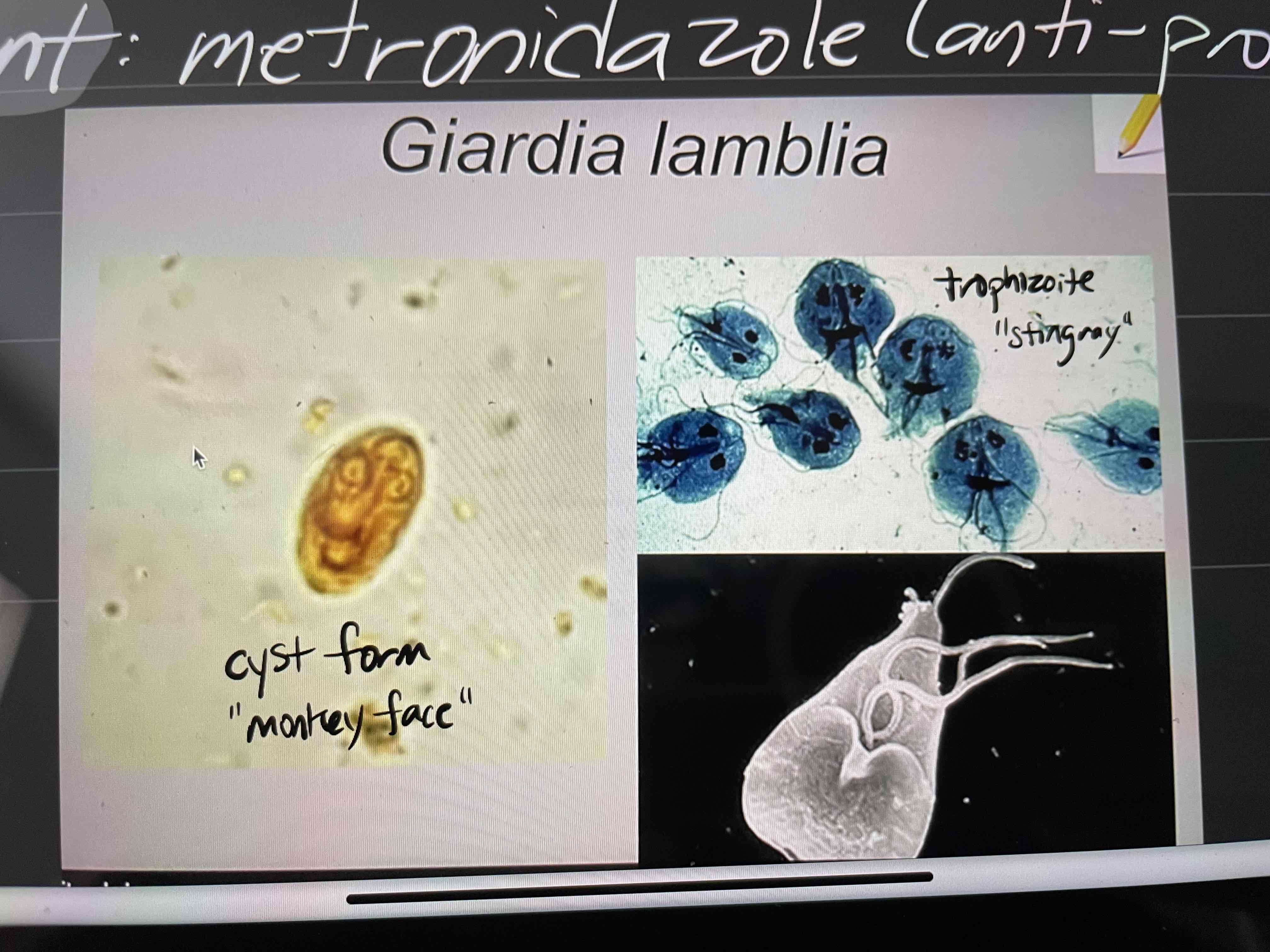 <p><strong>Type:</strong> protozoa</p><p><strong>Disease:</strong> giardiasis - diarrhea, inability to absorb fatty foods</p><p><strong>Pathogenesis:</strong></p><ul><li><p>Cyst ingested and becomes trophozoite in small intestines</p></li><li><p>Trophozoites attach to epithelial tissue → inflammation</p></li><li><p>Interferes with absorption of (fatty) food and fluids</p></li></ul><p><strong>Treatment: </strong>metronidazole (anti-protozoan drug)</p><p></p>