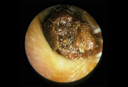 <p>cerumen impaction</p>