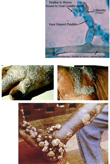 <p>Presents as a <strong>slow-growing, wart-like lesion</strong> on the <strong>legs or feet</strong>, often after trauma. It may ulcerate, crust, or show <strong>black dots</strong>. Caused by pigmented fungi; <strong>Medlar bodies</strong> seen on biopsy.</p><p><strong><em>“cauliflower-like” and “warty”</em></strong></p>