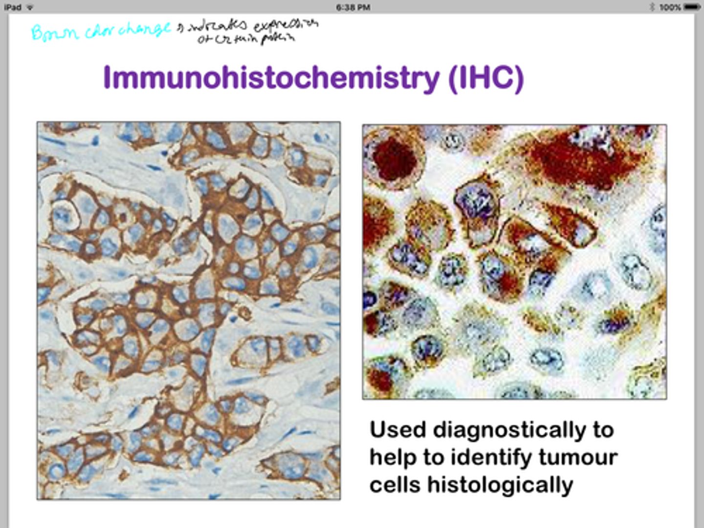 <p>Strong, continuous brown rings around the cell membrane.</p>