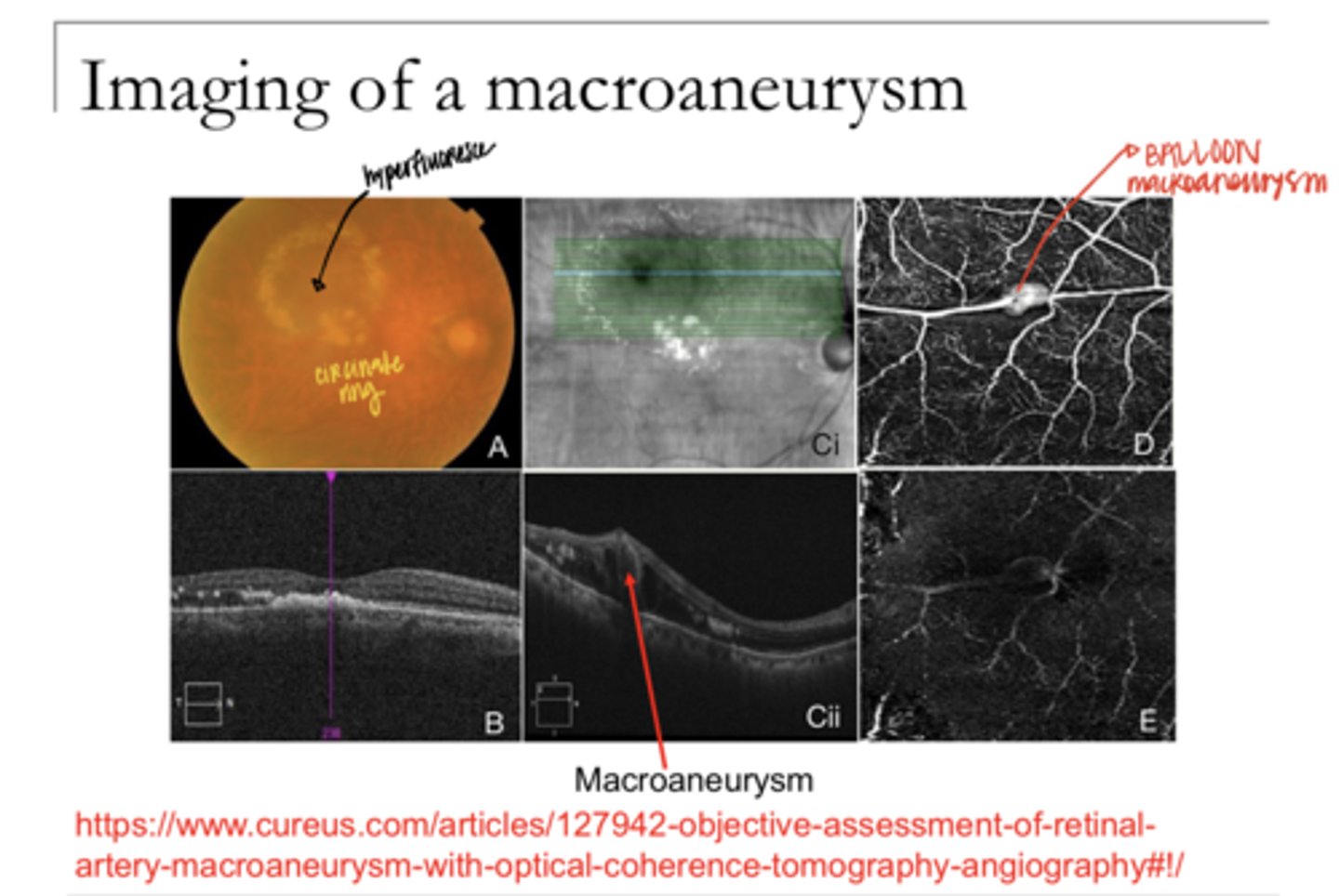 <p>Imaging of a Macroaneurysm (Pic)</p>