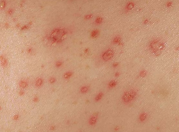 <p>This rash is called a macropapular rash. What disease is this indicative of? </p><p>a. Scarlet Fever</p><p>b. Rubella</p><p>c. Mononucleosis</p><p>d. Mumps</p>