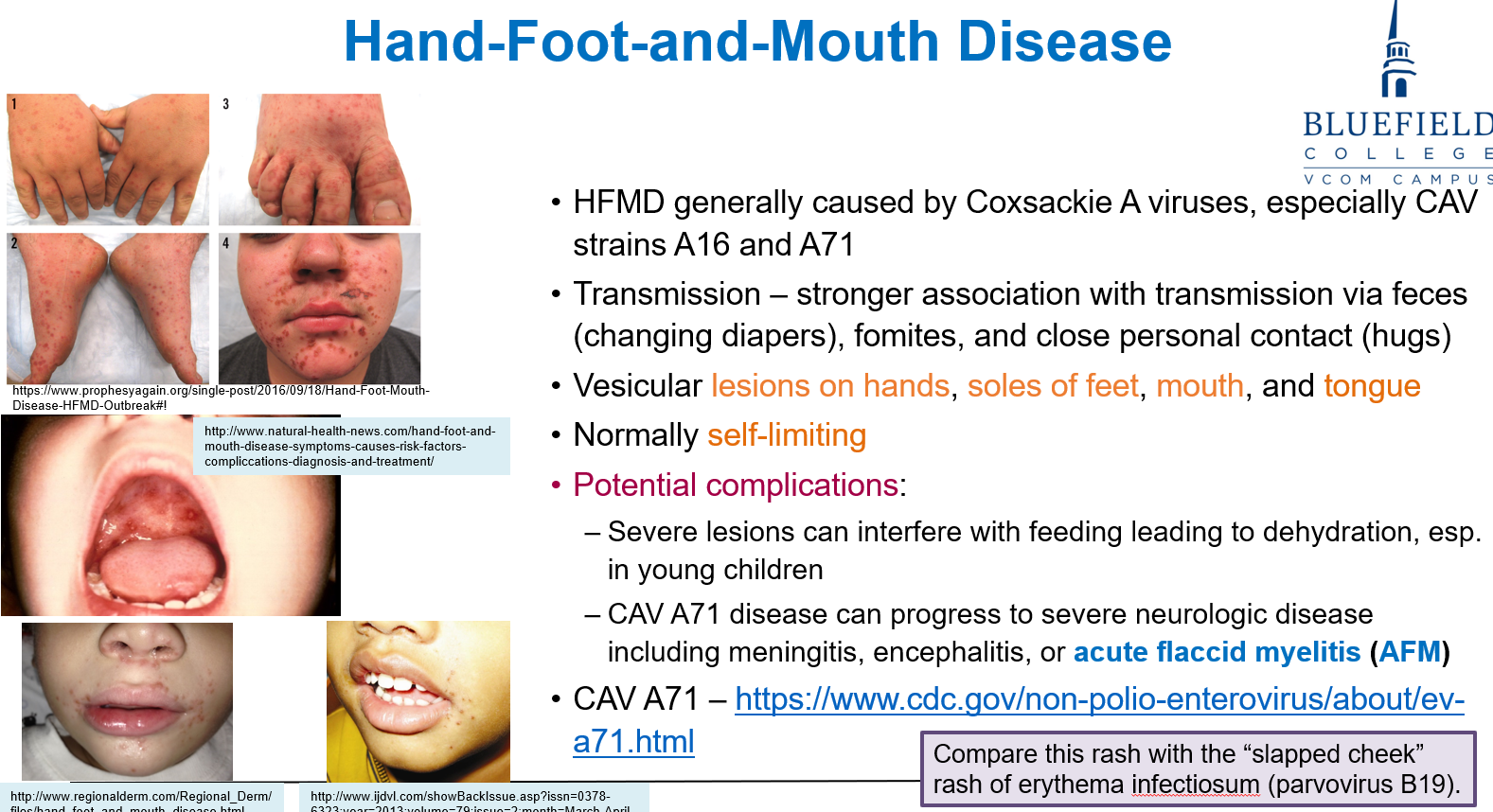 <p>By <strong>Coxsackie A viruses</strong>. It spreads through <strong>feces</strong> (diaper changes), <strong>fomites</strong>, and <strong>close contact</strong> (like hugs).</p>
