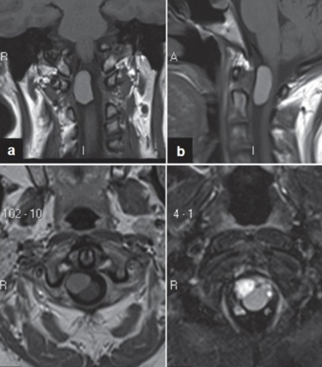 <p>neurenteric cyst</p>