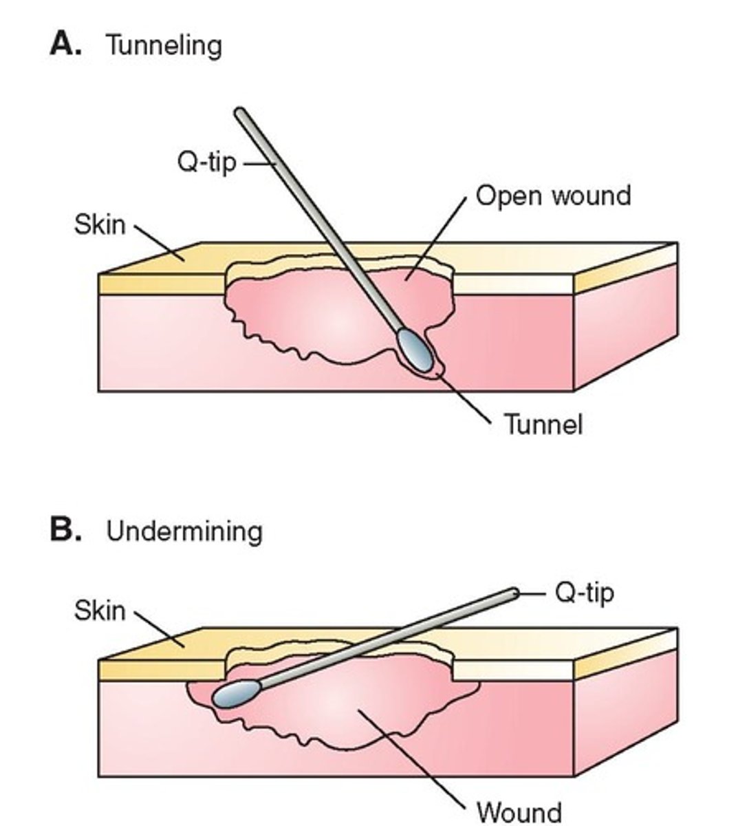 <p>Occurs when the tissue under the wound edges becomes eroded, resulting in a large wound underneath a small surface opening.</p>