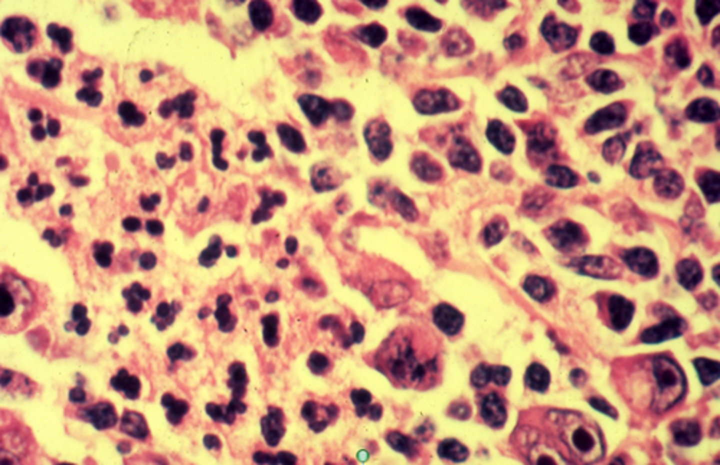 <p>Hodgkin Lymphoma</p><p>3 multiple choice options</p>